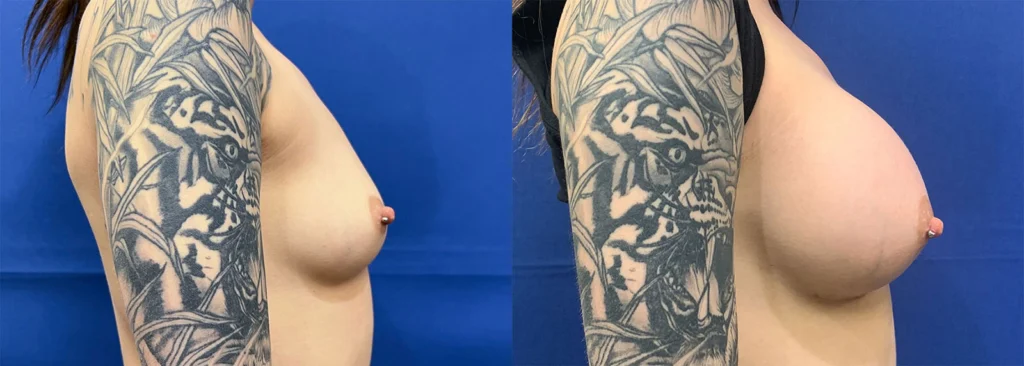breast augmentation before and after photo by john m compoginis md facs in newport beach ca