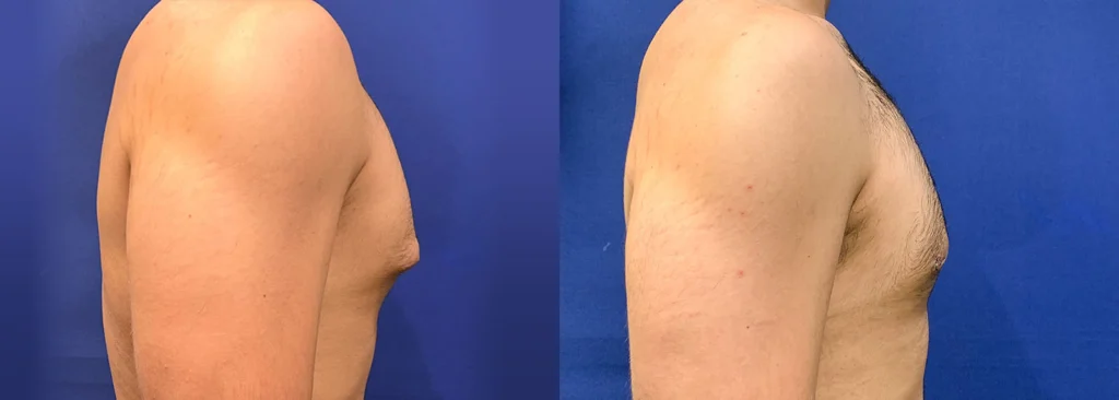 gynecomastia before and after photo by john m compoginis md facs in newport beach ca