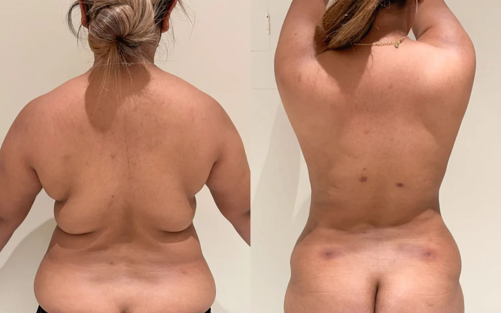 liposuction before and after photo by john m compoginis md facs in newport beach ca