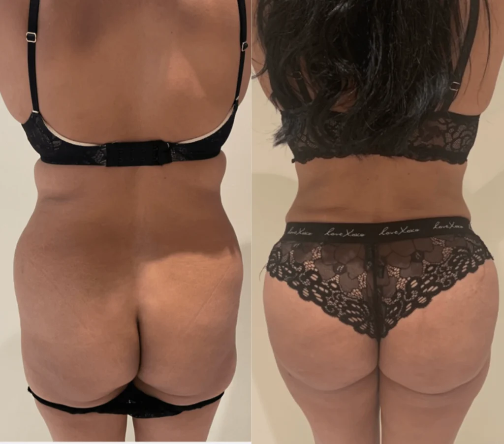 brazilian butt lift before and after photo by john m compoginis md facs in newport beach ca