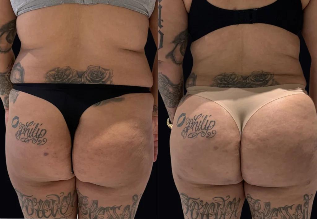 brazilian butt lift before and after photo by john m compoginis md facs in newport beach ca