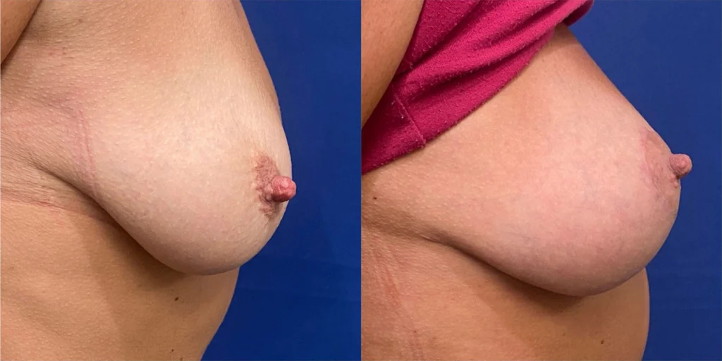 breast lift before and after photo by john m compoginis md facs in newport beach ca