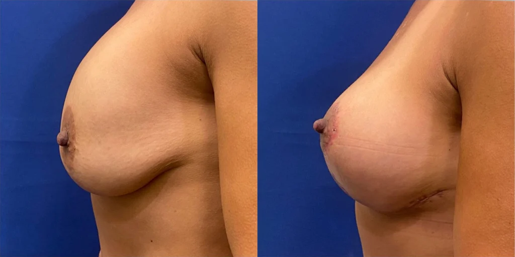 breast lift before and after photo by john m compoginis md facs in newport beach ca