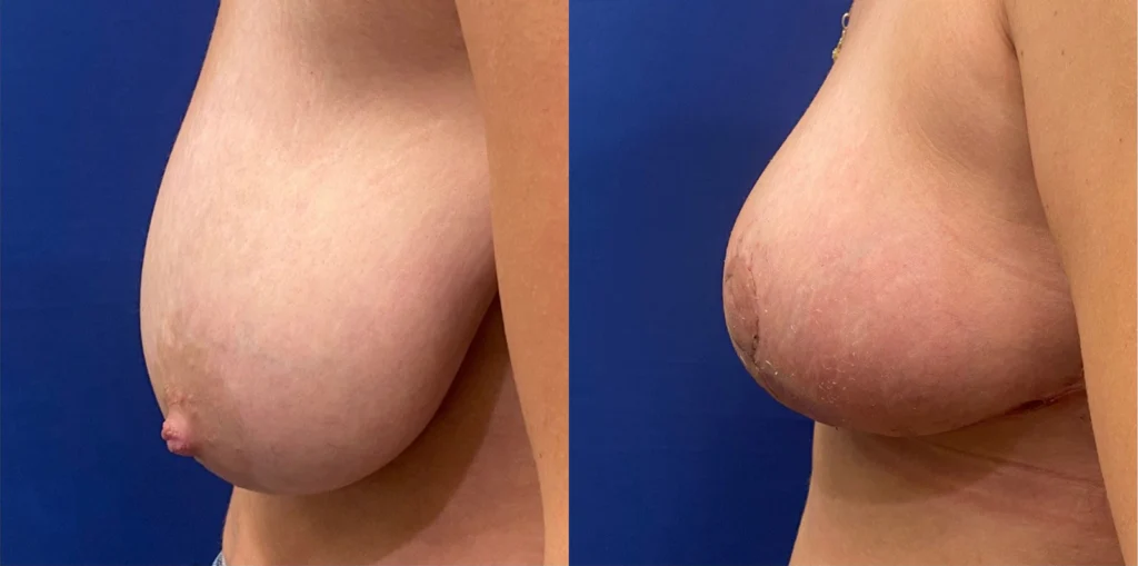 breast lift before and after photo by john m compoginis md facs in newport beach ca