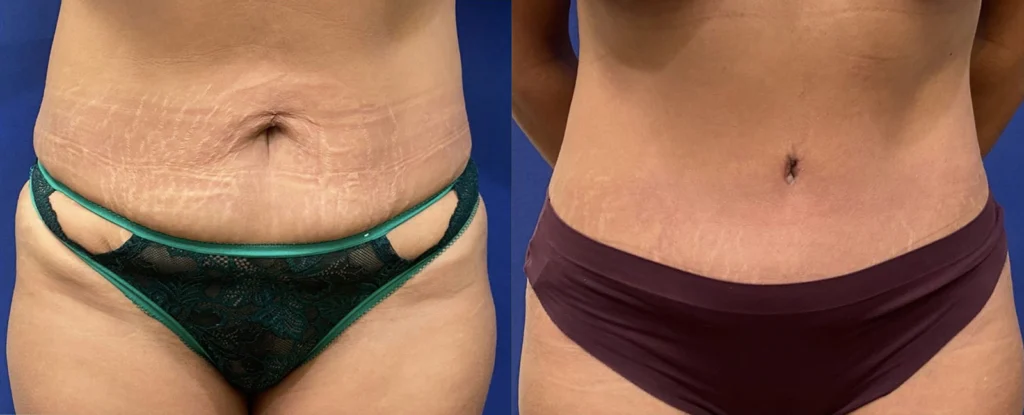 tummy tuck before and after photo by john m compoginis md facs in newport beach ca