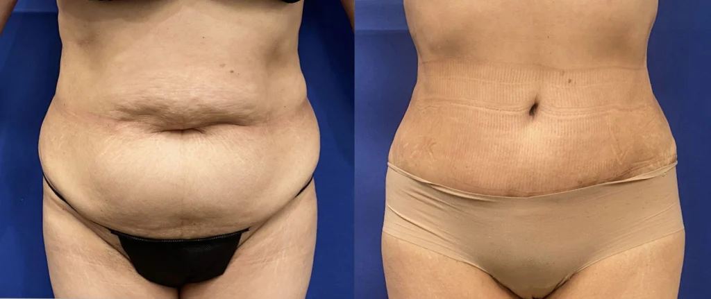 tummy tuck before and after photo by john m compoginis md facs in newport beach ca