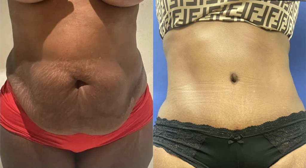 tummy tuck before and after photo by john m compoginis md facs in newport beach ca