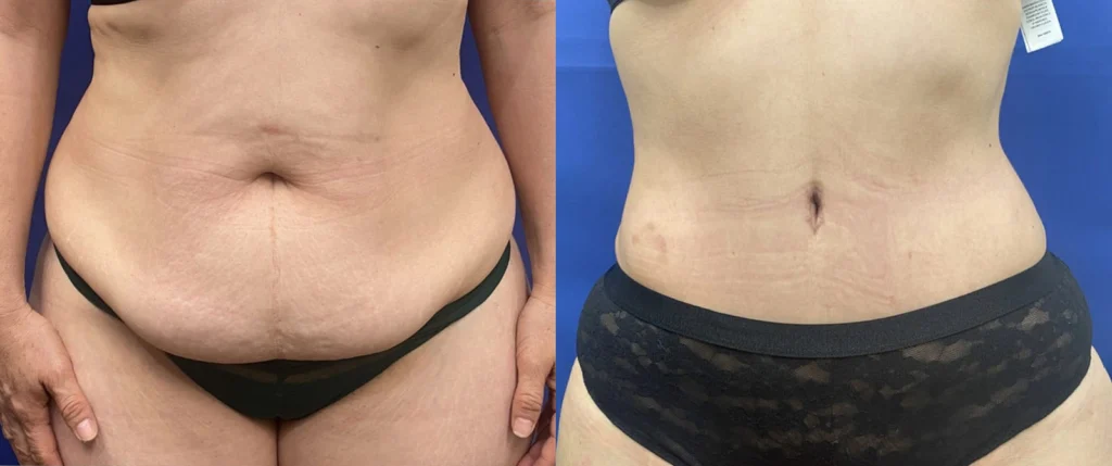 tummy tuck before and after photo by john m compoginis md facs in newport beach ca