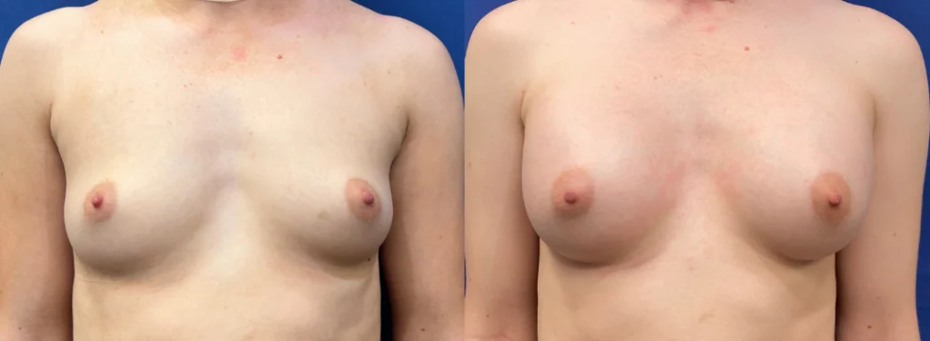 breast augmentation before and after photo by john m compoginis md facs in newport beach ca