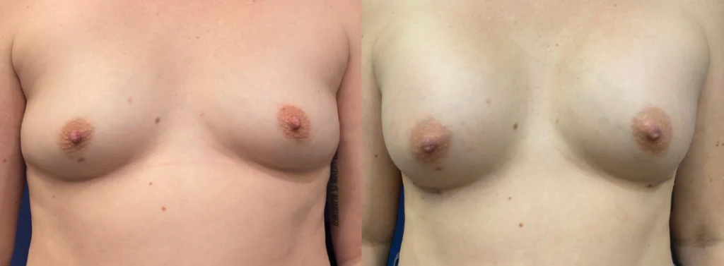 breast augmentation before and after photo by john m compoginis md facs in newport beach ca