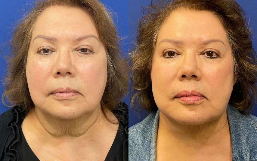 facelift before and after photo by john m compoginis md facs in newport beach ca