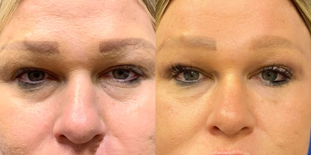 fat grafting before and after photo by john m compoginis md facs in newport beach ca