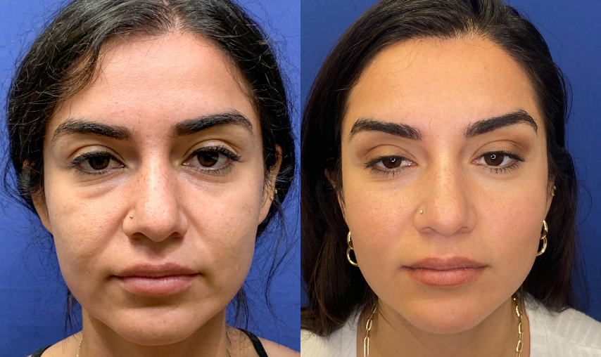 fat grafting before and after photo by john m compoginis md facs in newport beach ca