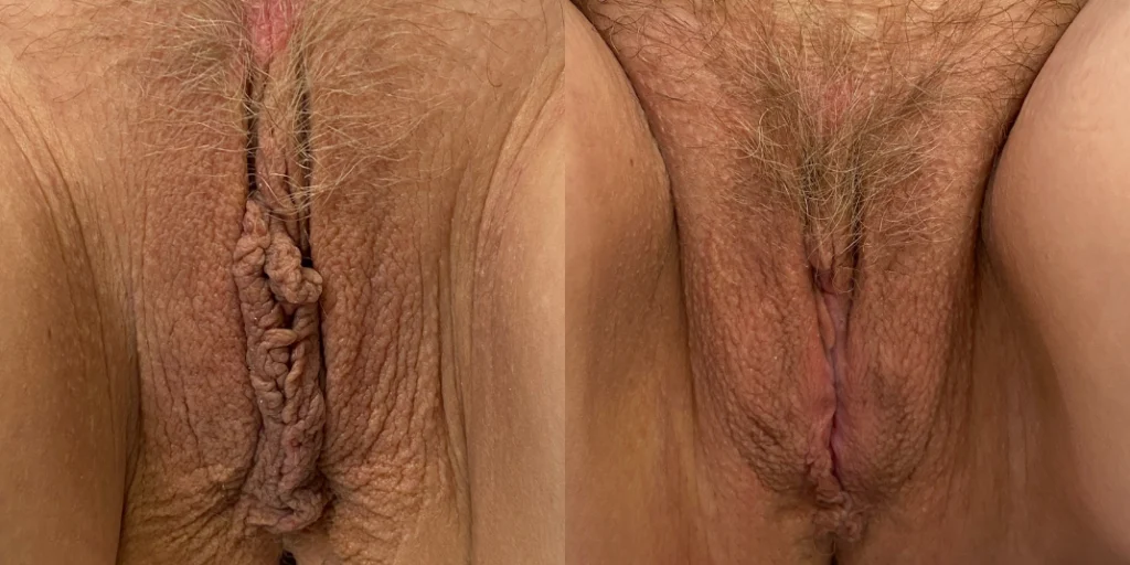 labiaplasty before and after photo by john m compoginis md facs in newport beach ca