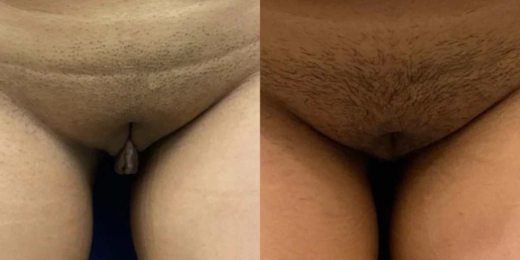 labiaplasty before and after photo by john m compoginis md facs in newport beach ca