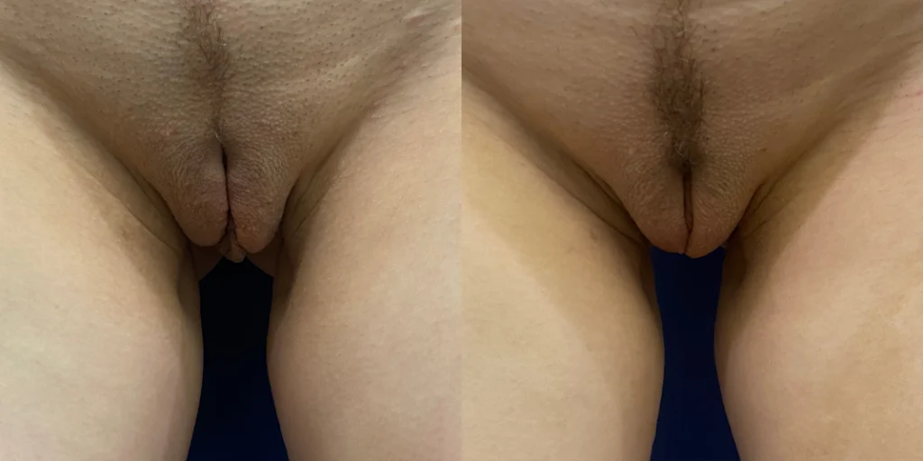 labiaplasty before and after photo by john m compoginis md facs in newport beach ca