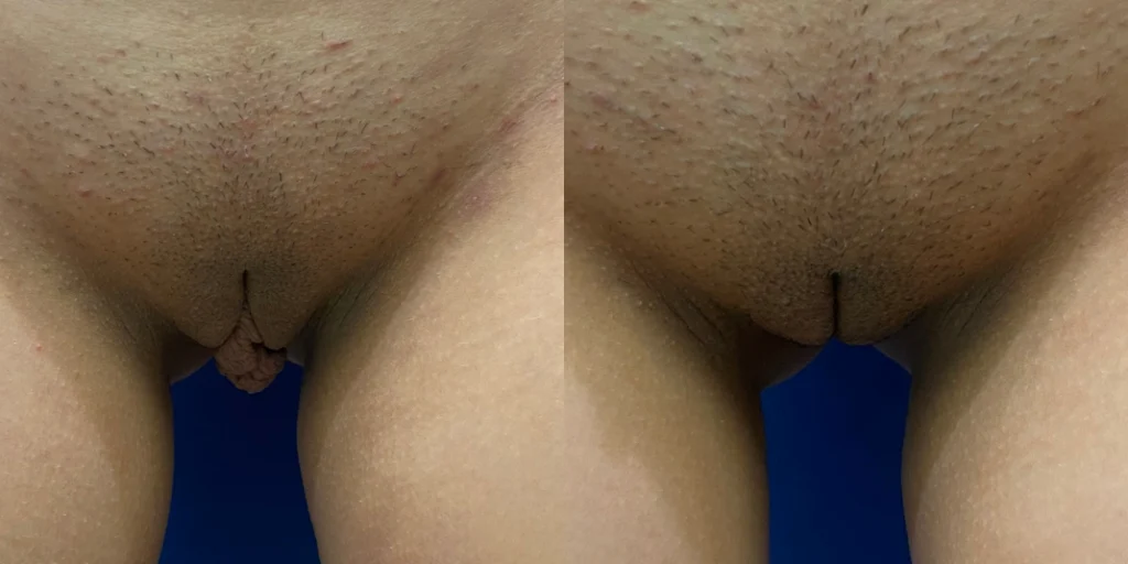 labiaplasty before and after photo by john m compoginis md facs in newport beach ca