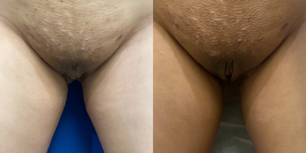 labiaplasty before and after photo by john m compoginis md facs in newport beach ca