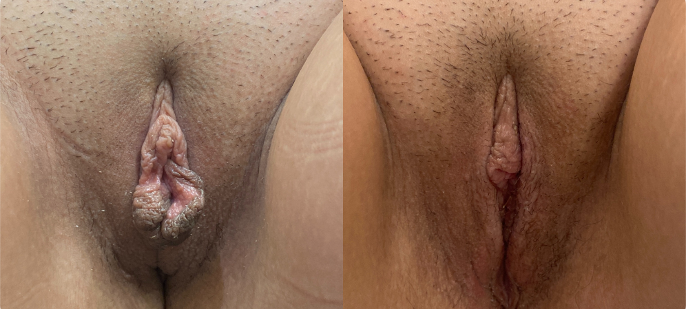labiaplasty before and after photo by john m compoginis md facs in newport beach ca
