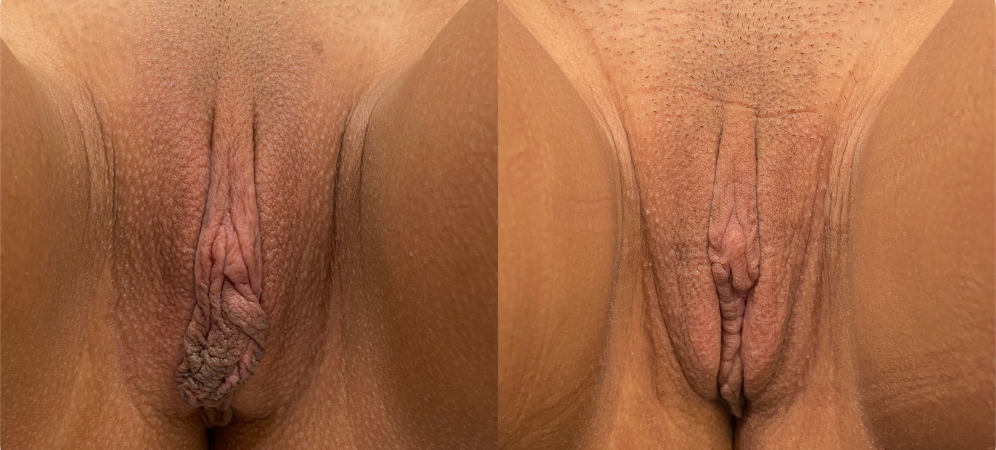 labiaplasty before and after photo by john m compoginis md facs in newport beach ca
