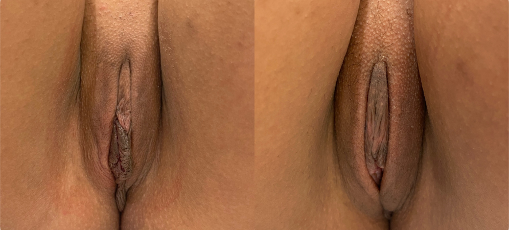 labiaplasty before and after photo by john m compoginis md facs in newport beach ca