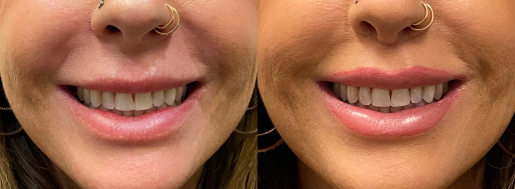 lip enhancement before and after photo by john m compoginis md facs in newport beach ca