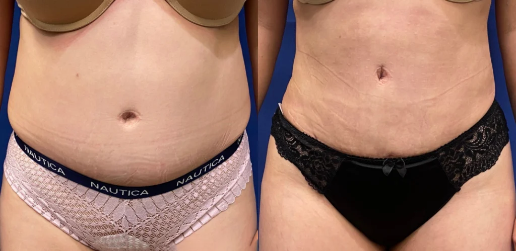 mommy makeover before and after photo by john m compoginis md facs in newport beach ca
