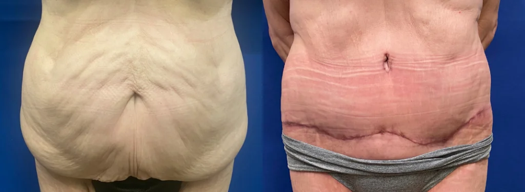 mommy makeover before and after photo by john m compoginis md facs in newport beach ca