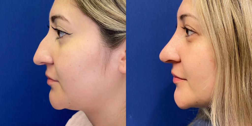 rhinoplasty before and after photo by john m compoginis md facs in newport beach ca