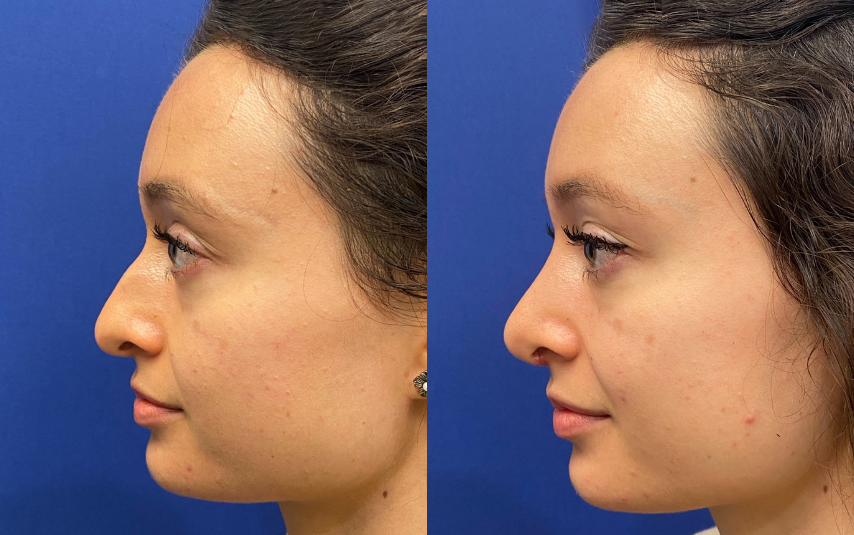 rhinoplasty before and after photo by john m compoginis md facs in newport beach ca