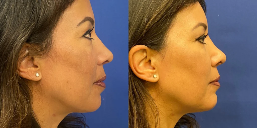 rhinoplasty before and after photo by john m compoginis md facs in newport beach ca