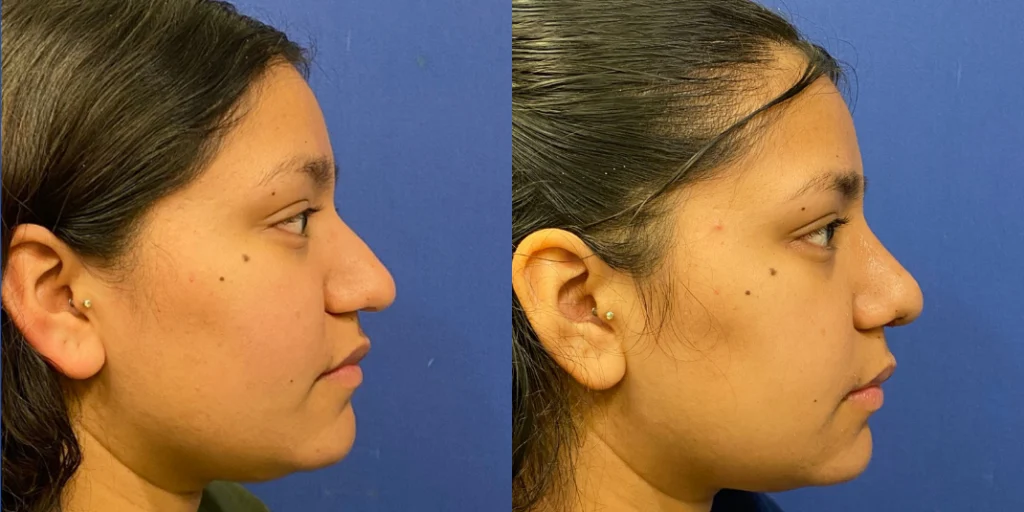 rhinoplasty before and after photo by john m compoginis md facs in newport beach ca