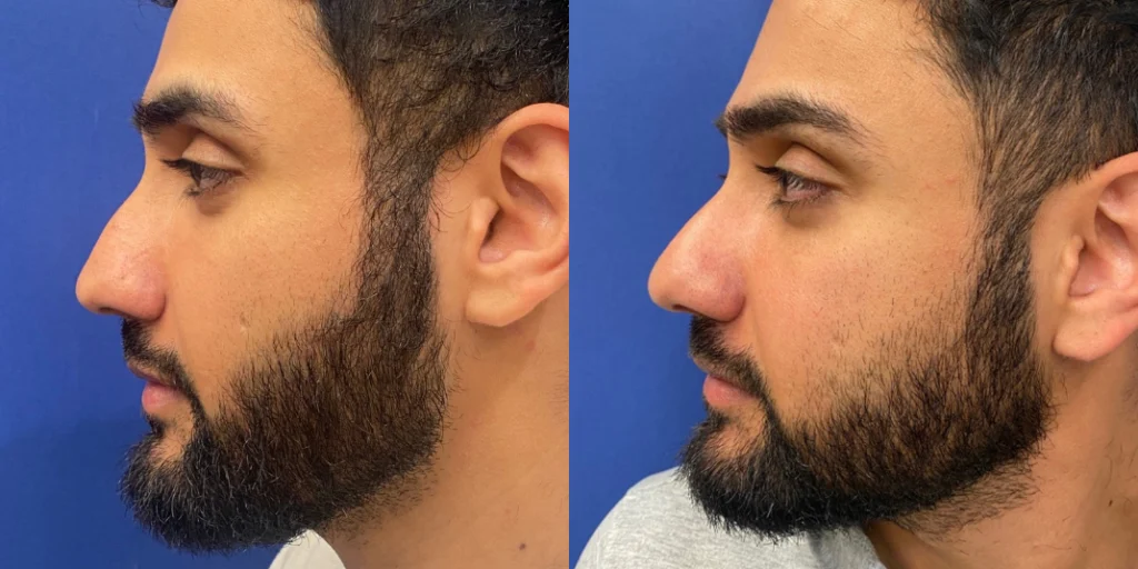 rhinoplasty before and after photo by john m compoginis md facs in newport beach ca