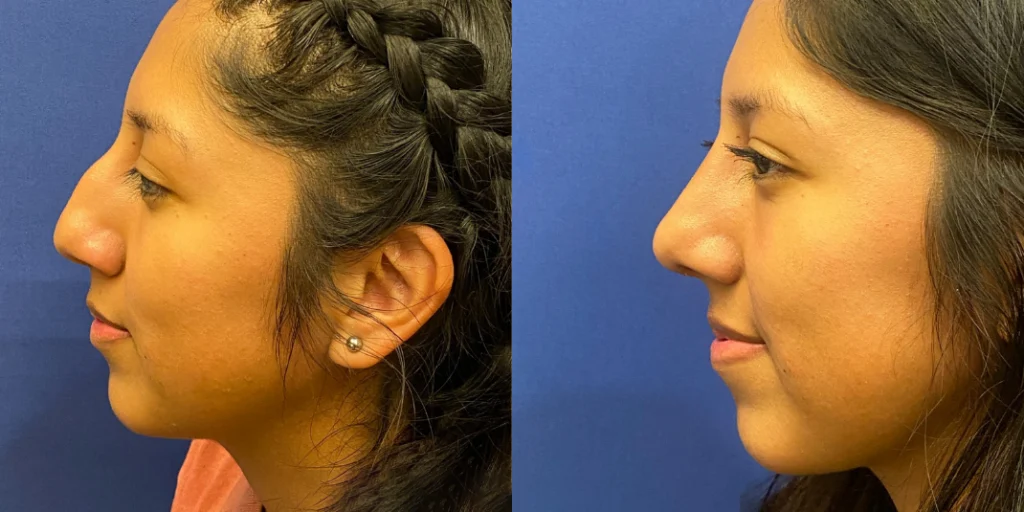 rhinoplasty before and after photo by john m compoginis md facs in newport beach ca