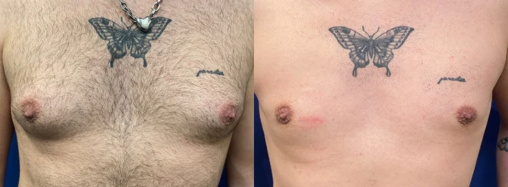 gynecomastia before and after photo by john m compoginis md facs in newport beach ca