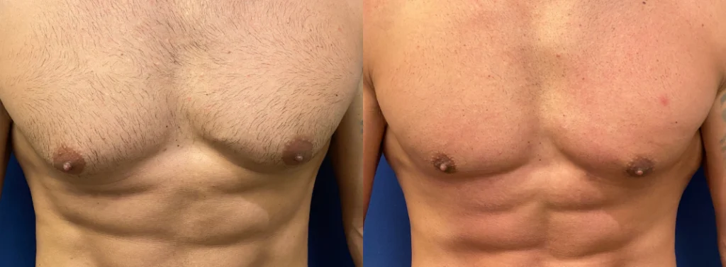gynecomastia before and after photo by john m compoginis md facs in newport beach ca