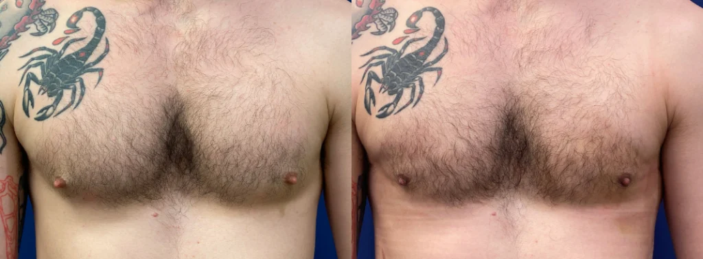gynecomastia before and after photo by john m compoginis md facs in newport beach ca