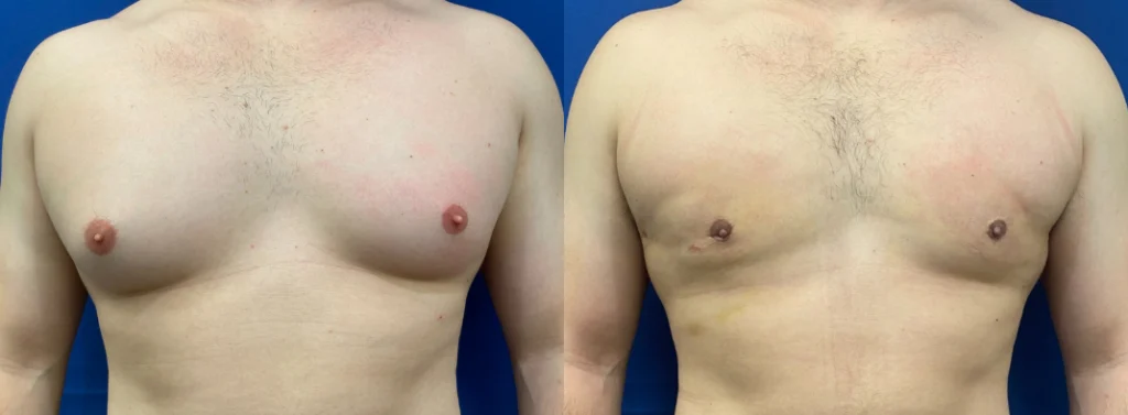 gynecomastia before and after photo by john m compoginis md facs in newport beach ca