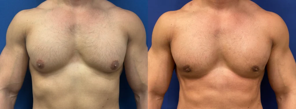 gynecomastia before and after photo by john m compoginis md facs in newport beach ca