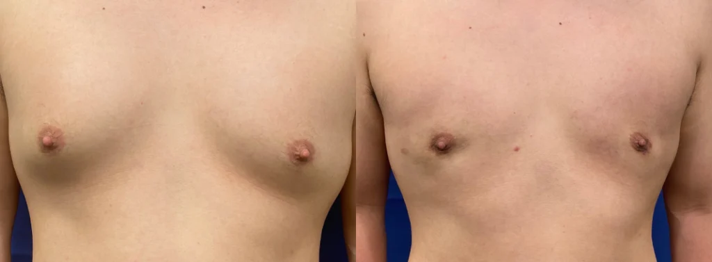 gynecomastia before and after photo by john m compoginis md facs in newport beach ca