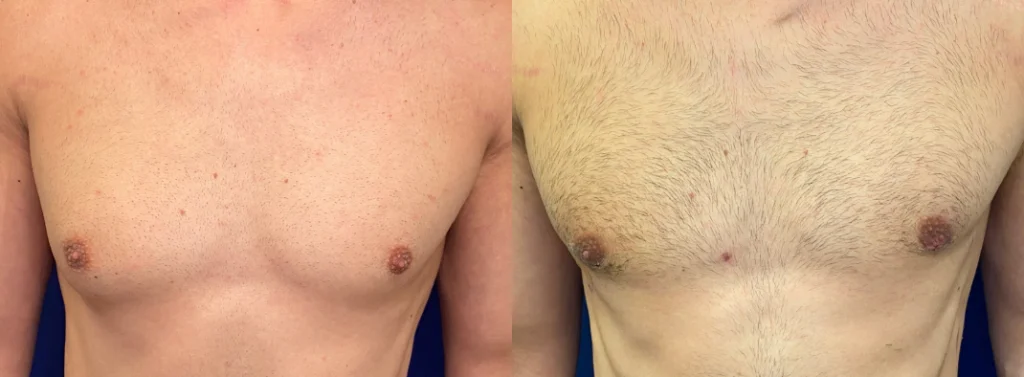 gynecomastia before and after photo by john m compoginis md facs in newport beach ca