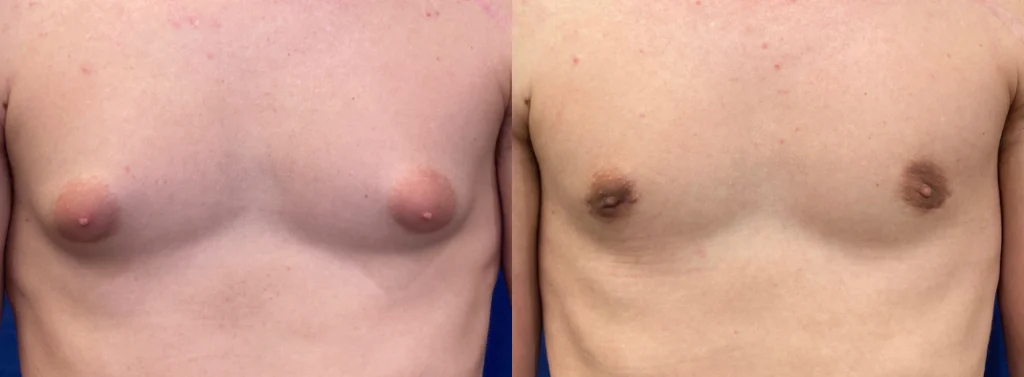 gynecomastia before and after photo by john m compoginis md facs in newport beach ca