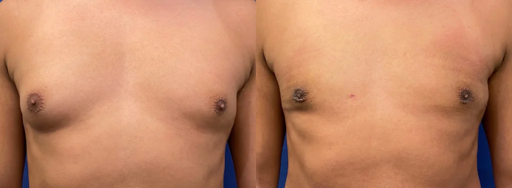 gynecomastia before and after photo by john m compoginis md facs in newport beach ca