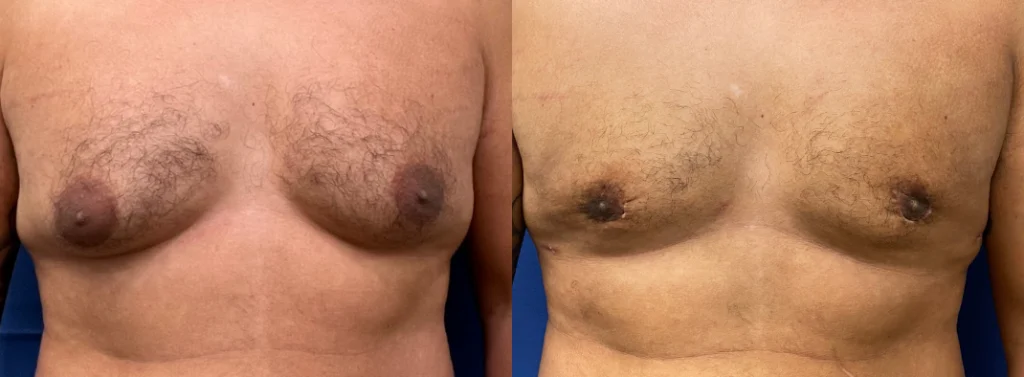 gynecomastia before and after photo by john m compoginis md facs in newport beach ca