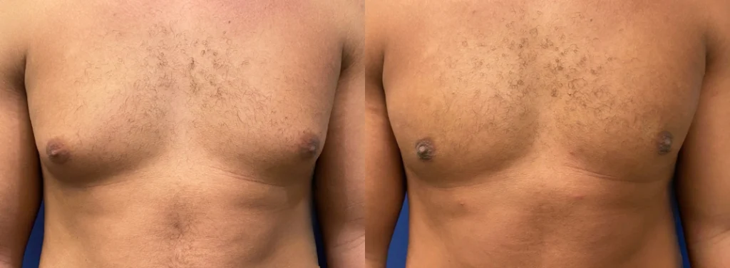 gynecomastia before and after photo by john m compoginis md facs in newport beach ca