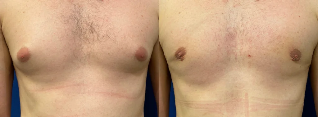 gynecomastia before and after photo by john m compoginis md facs in newport beach ca