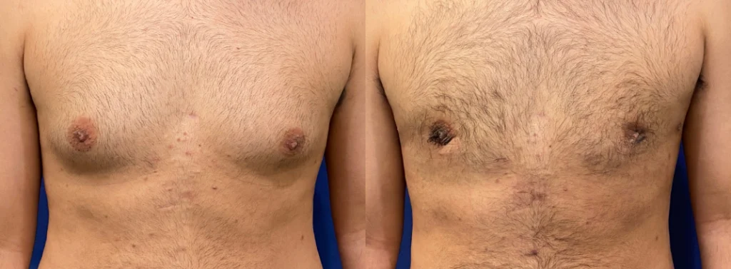 gynecomastia before and after photo by john m compoginis md facs in newport beach ca