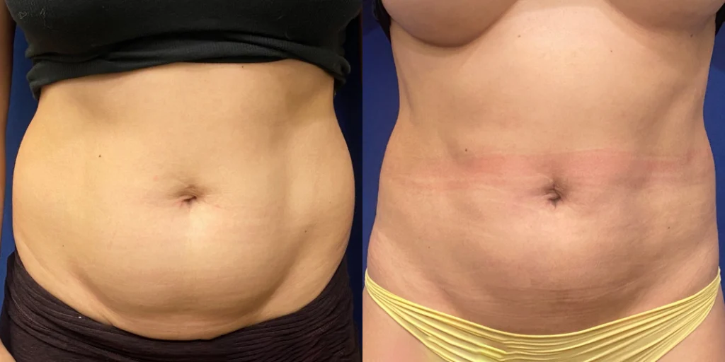 liposuction before and after photo by john m compoginis md facs in newport beach ca