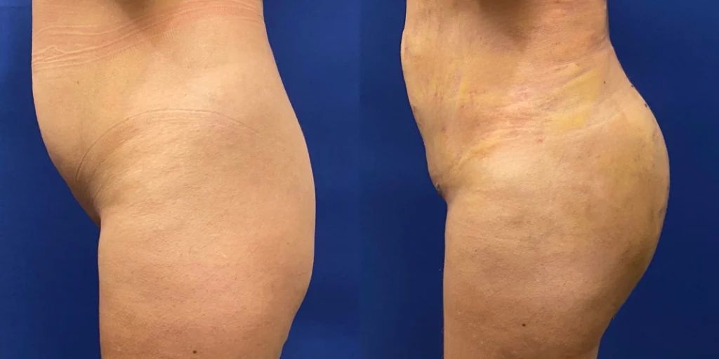 brazilian butt lift before and after photo by john m compoginis md facs in newport beach ca