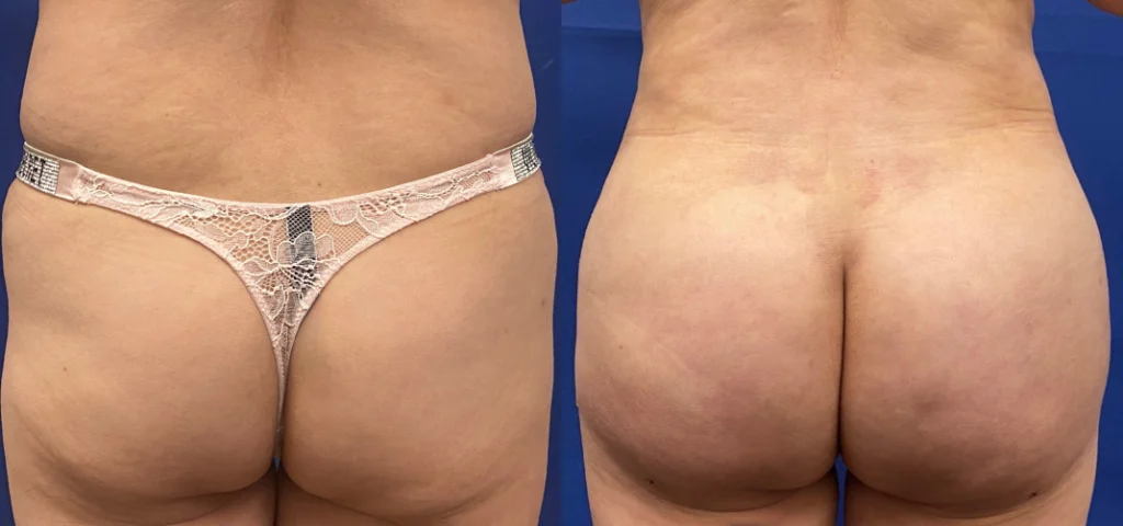 brazilian butt lift before and after photo by john m compoginis md facs in newport beach ca